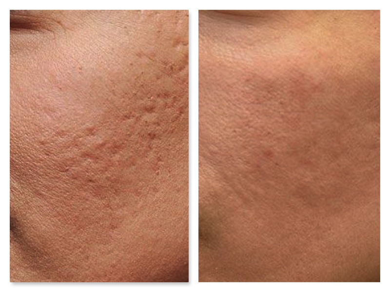 Laser Cicatrici Acne Prima E Dopo