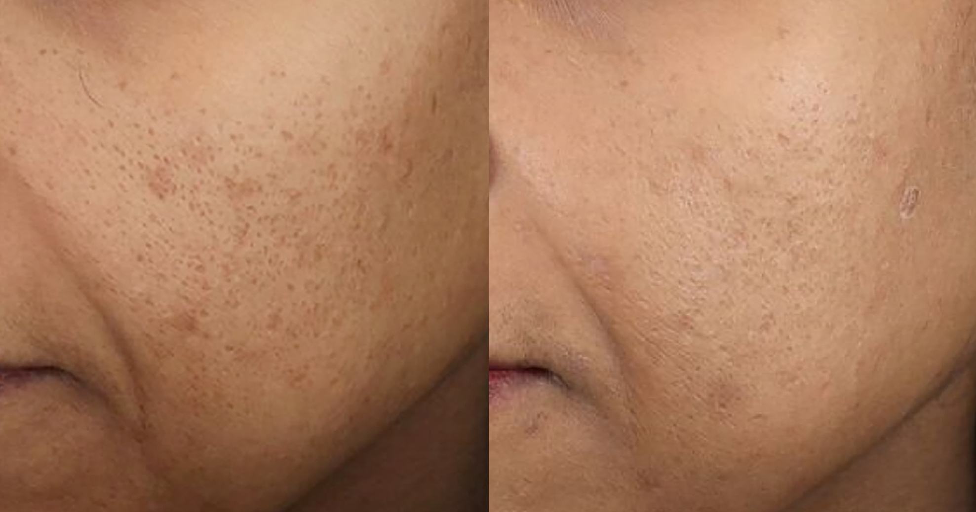 Come Eliminare le Cicatrici da Acne? Scopri le tecniche Laser