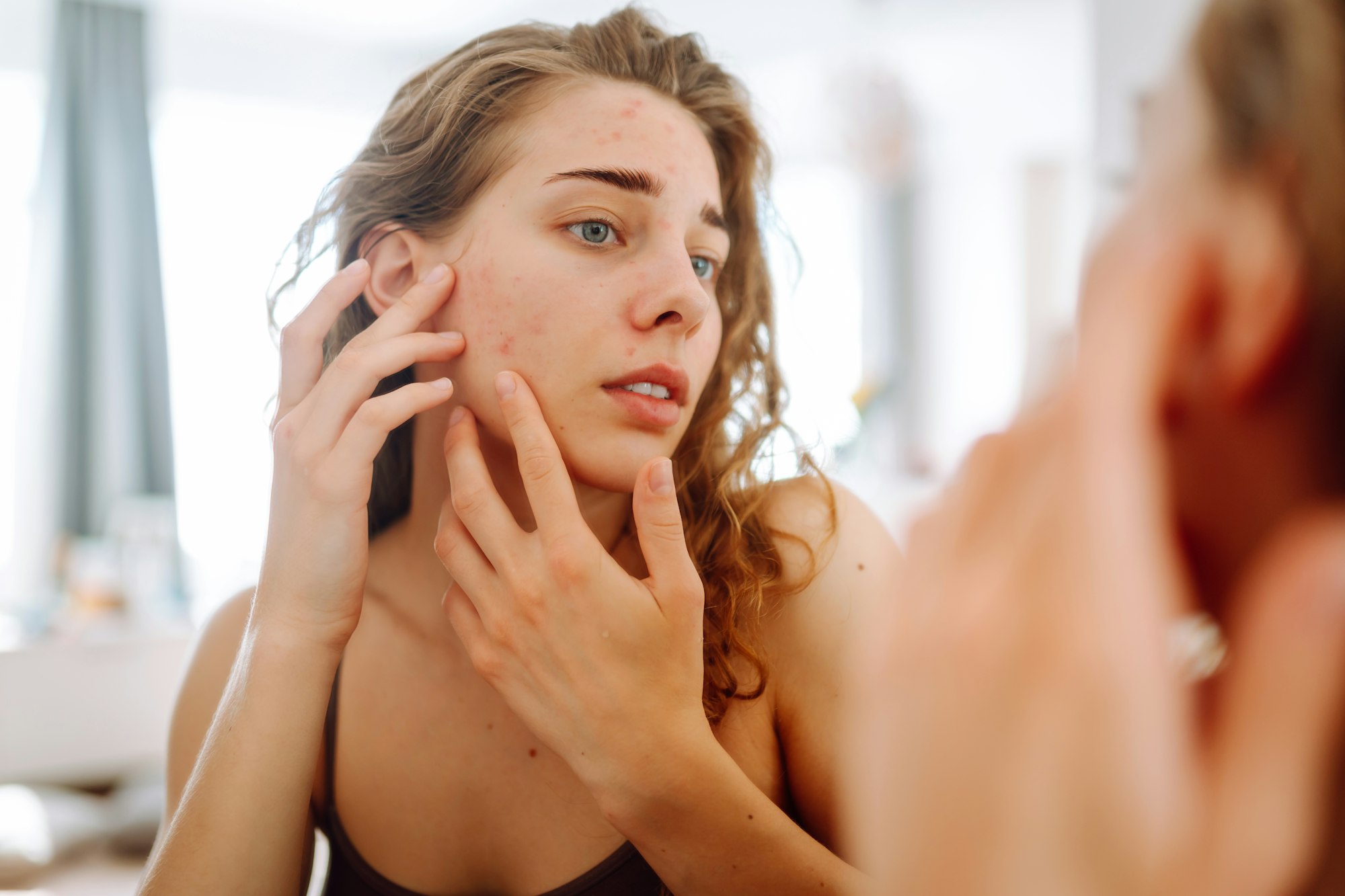 Young woman looks in mirror examining inflammation on her face. Acne skin. Medicine and cosmetology.